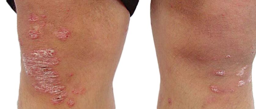 Psoriáza je nepríjemné ochorenie kože, ktoré si vyžaduje ošetrenie krémom Keraderm