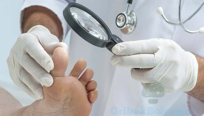 diagnostika plesní na nohách lekárom