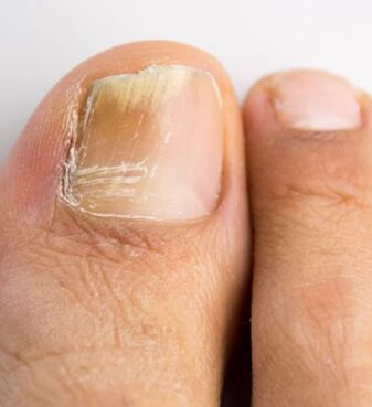 Huba nechtov na palci nohy, ktorá sa vyskytuje na pozadí slabej imunity