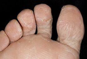 Koža nôh s plesňovou infekciou