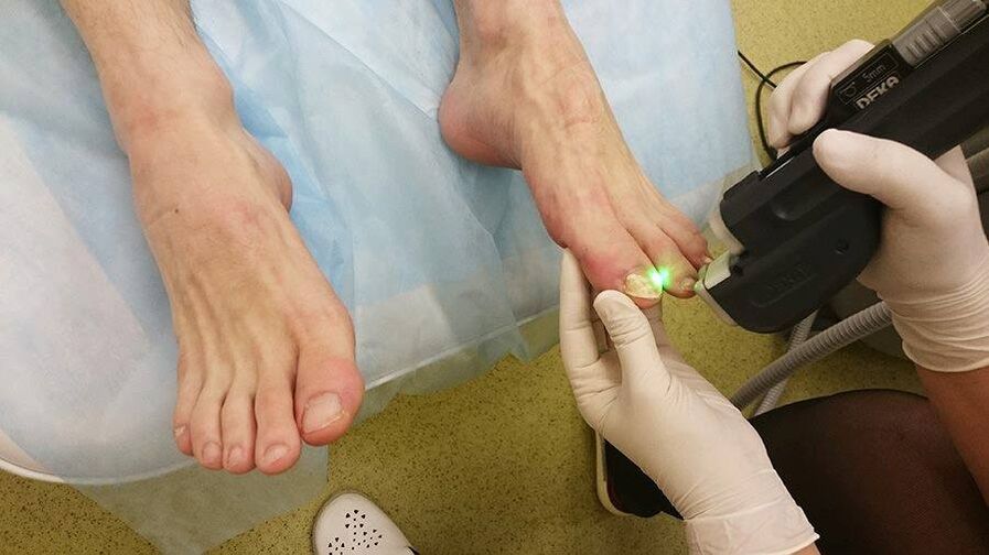 Laserové ošetrenie plesní nechtov na nohách