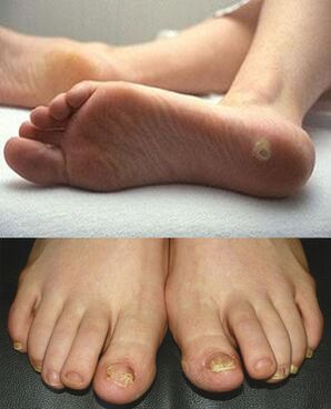 Prejavy mykózy na koži a nechtoch nôh
