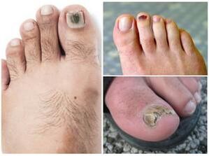 Príznaky plesňovej infekcie nechtov na nohách