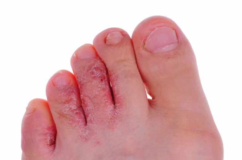 Príznaky rubrofytózy - praskliny a šupiny na koži nôh