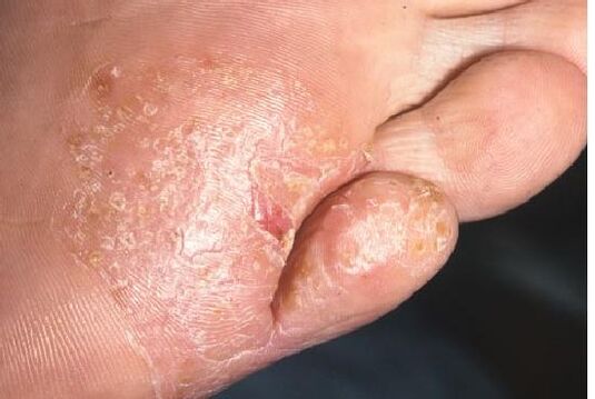 Prejavy plesňovej infekcie na koži nohy