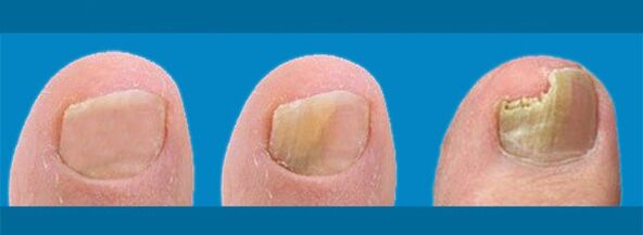 Vývoj onychomykózy - huba nechtov na nohách